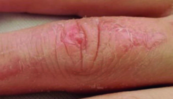 dog bite after 6 months