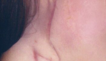 Case study start therapy scar